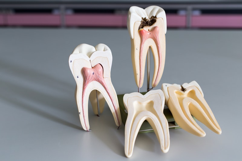 Picture of the insides of four teeth models to see a healthy vs. infected tooth
