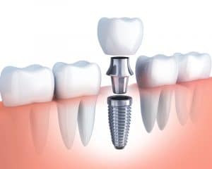 Animated model of the three parts of a dental implant.