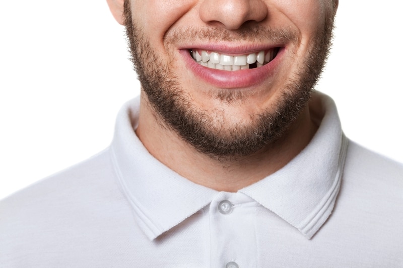 Young man smiling with one tooth missing.